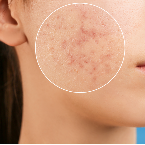5 Surprising Causes Of Adult Acne